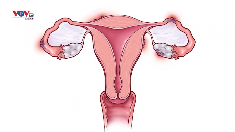 Lạc nội mạc tử cung: Nguyên nhân, triệu chứng, điều trị và phòng ngừa