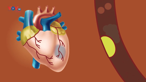 Bệnh mạch vành “trẻ hóa” và những phương pháp phòng bệnh